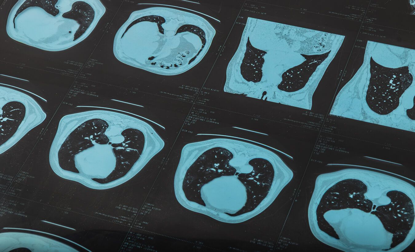 Medical professionals analyzing chest imaging scans on a computer to detect a possible cancerous mass in a delayed diagnosis case
